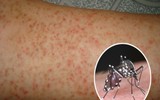 [ẢNH] Những loại bệnh dịch phổ biến do thời tiết ở Việt Nam